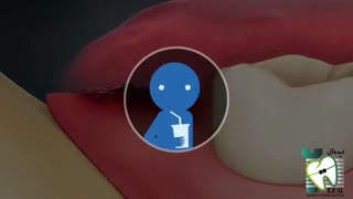 جراحی دندان عقل | کلینیک دندانپزشکی ایده آل