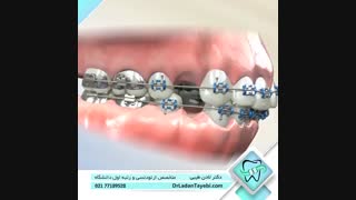 تاثیر ارتودنسی روی لب ها | دکتر لادن طیبی