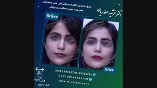 نمونه جراحی های بینی دکتر فرشید صفدریان کلینیک لیزر