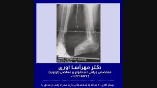 عمل جراحی شکستگی باز در ساق پا