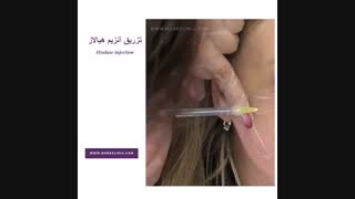 تزریق آنزیم هیالورونید