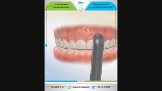 افزایش طول تاج  و gummy smile با لیزر | دکتر شبنم میلانی