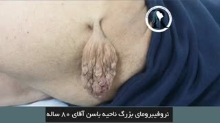 جراحی نروفیبرومای بزرگ در ناحیه باسن بیمار 80 ساله