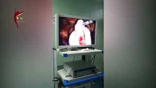 عمل لاپاراسکوپی