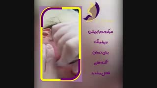 درمان آکنه با میکرودرم ابریژن