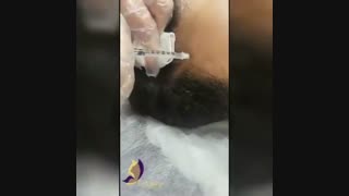 درمان ریزش مو با مزوتراپی مو