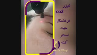 درمان اسکار آکنه با لیزر CO2 فرکشنال