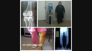 قبل و بعد استبدال مفصل الیساری