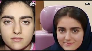 سی و هشت روز بعد از عمل بینی | دکتر امید ابراهیمی