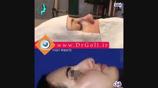 بلافاصله بعد از جراحی بینی | دکتر گلی