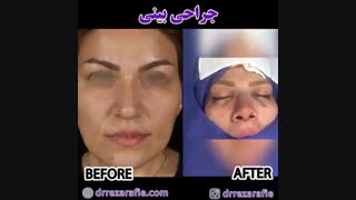 جراحی بینی | دکتر رفیع