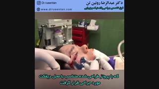 بیمار با تخریب ریم فوقانی لترال وتحتانی اربیت راست