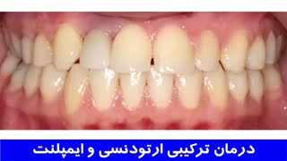 درمان ترکیبی ارتودنسی و ایمپلنت | دکتر احسان مهریزی