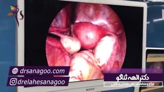 جراحی لاپاراسکوپی کیست درموئید