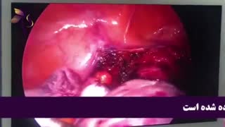 لاپاراسکوپی درآوردن رحم