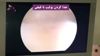 هیستروسکوپی در خانم ٥٦ ساله به علت افزایش ضخامت اندومتر