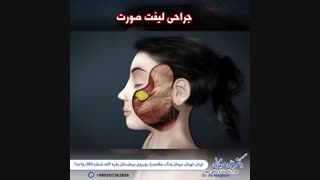انیمیشن جراحی لیفت صورت