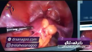 جراحی هیستروسکوپی