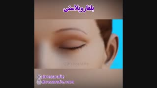 انیمیشن جراحی زیبایی پلک | دکتر رفیع