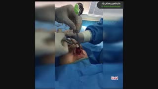 جراحی ترمیم بینی در بینی با اسکلت نامتقارن