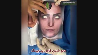 جراحی بینی طبیعی