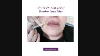 درمان چروک دور چشم اصلاح طرح لبخند