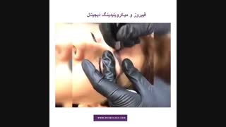 فیبروز ابرو