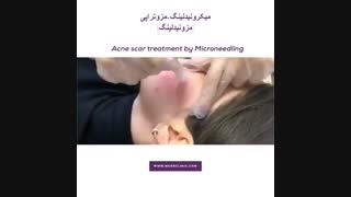 مزونیدلینگ