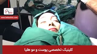 کاشت ابرو به روش میکروگرافت | کلینیک هلیا | 02122810089 | شماره 1