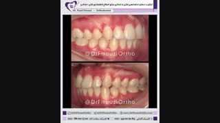 ترکیب درمان ارتودنسی فکی و دندانی برای اصلاح ناهنجاری فکی دندانی | دکتر فیروزی