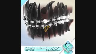 درمان دندان نیش نهفته | دکتر لادن طیبی