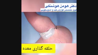 انیمیشن حلقه گذاری معده