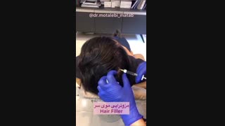 مزوتراپی موی سر