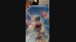 پیچیده شدن دو دور بند ناف دور گردن جنین