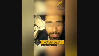 تزریق فیلر گونه