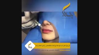 تزریق فیلر لب