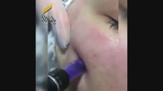 میکرونیدلینگ جهت رفع لک و جای جوش