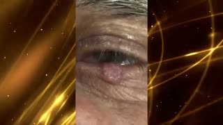 جراحی تومور بدخیم لبه ی پلک