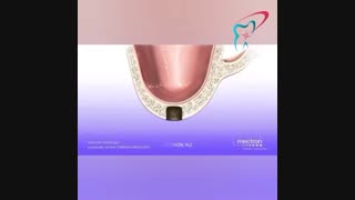 جراحی سینوس لیفت (بالا بردن سینوس ) جهت قراردادن ایمپلنت دندان