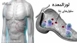 درمان قطعی دیابت نوع یک و دو در طب سنتی