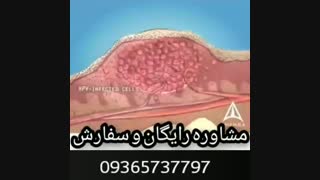 چرا فریز کردن راهکار قطعی درمان زگیل تناسلی نیست؟؟
