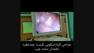 جراحی لاپاراسکوپی کیست تخمدان