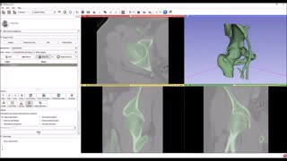 Creating femur model from CT volume using 3D Slicer