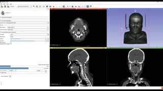 Creating 3D Printable Medical Models for Free: Embodi3D.com, 3D Slicer, and Meshmixer