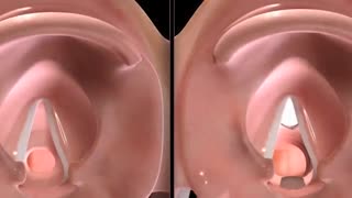 فیلم جراحی بازسازی حنجره به کمک غضروف دنده