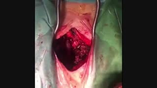 درمان درد کمر و رادیوکولوپاتی