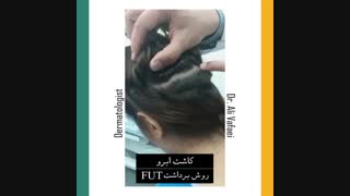 کاشت ابرو
