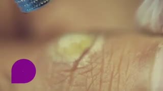 کرایوتراپی برای درمان زگیل های پوستی دندان مصنوعی