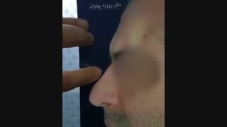 جراحی بینی با پوست ضخیم