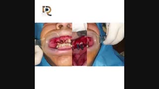 بازسازی کامل فک فوقانی